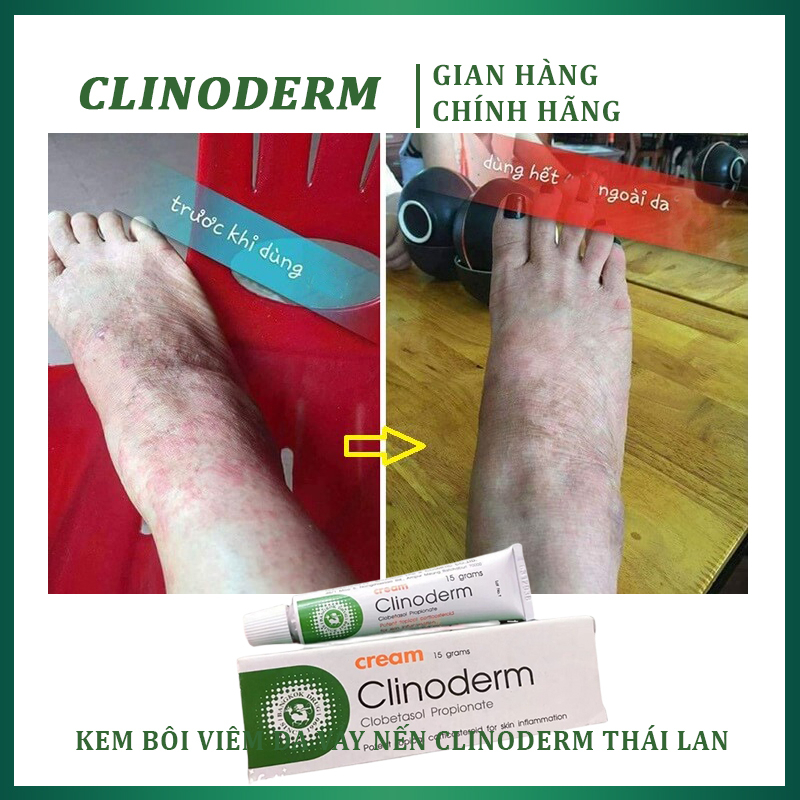 body-kem-boi-da-dieu-tri-vay-nen-clinodermtuyp15gthai-0938416889-7071