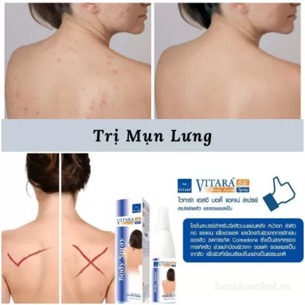 san-pham-khac-xit-tri-mun-lung-vitara-se-body-acne-spray-50ml-thai-lan-5873
